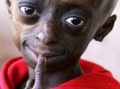 progeria-AP110824079526.jpg progeria-AP110824079526.jpg